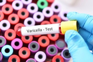 Varicella Antibody Test